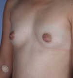 Breast Augmentation Before and after photo