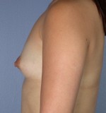 Breast Augmentation Before and after photo