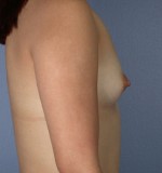 Breast Augmentation Before and after photo