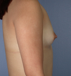 Breast Augmentation before and after photo