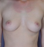 Breast Augmentation Before and after photo