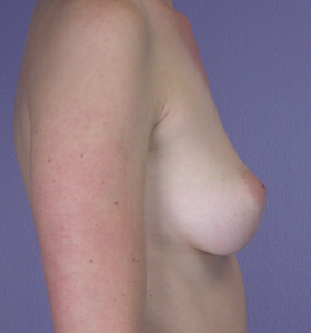 Breast Augmentation before and after photo