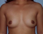 Breast Augmentation Before and after photo