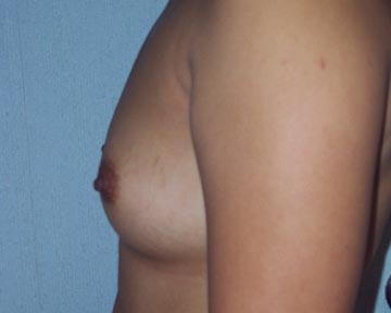 Breast Augmentation before and after photo