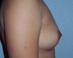 Breast Augmentation Before and after photo