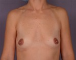 Breast Augmentation Before and after photo