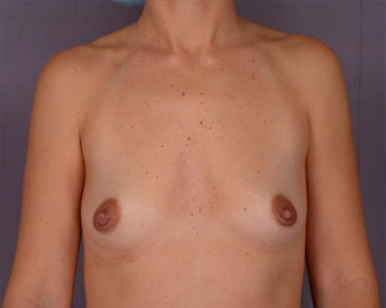 Breast Augmentation before and after photo