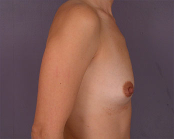 Breast Augmentation before and after photo