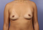 Breast Augmentation Before and after photo