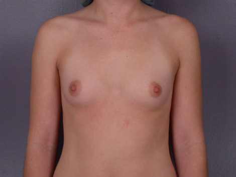 Breast Augmentation before and after photo