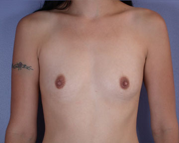 Breast Augmentation before and after photo