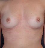 Breast Augmentation Before and after photo