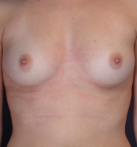 Breast Augmentation before and after photo