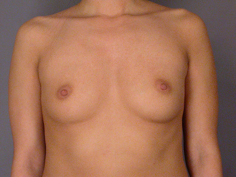 Breast Augmentation before and after photo