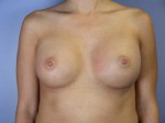 Breast Augmentation Before and after photo