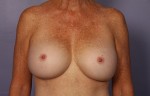 Breast Augmentation Before and after photo