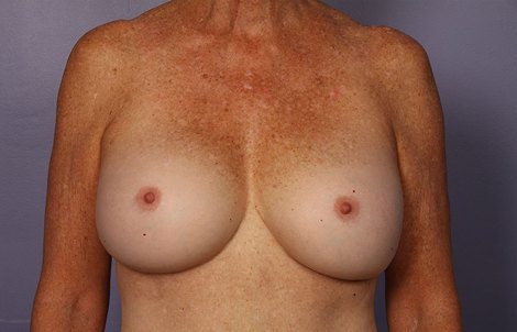 Breast Augmentation before and after photo