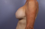 Breast Augmentation Before and after photo