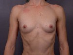 Breast Augmentation Before and after photo