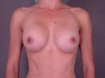 Breast Augmentation