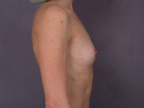 Breast Augmentation before and after photo