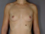 Breast Augmentation Before and after photo