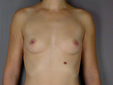 Breast Augmentation before and after photo