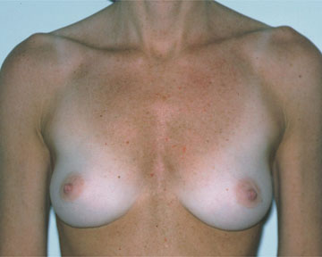 Breast Augmentation before and after photo