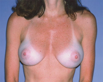 Breast Augmentation before and after photo