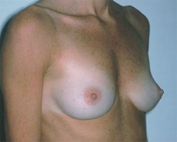 Breast Augmentation before and after photo