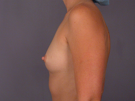 Breast Augmentation before and after photo