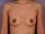 Breast Augmentation Before and after photo