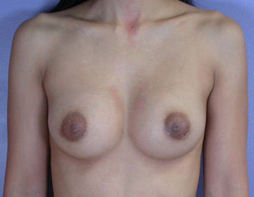 Breast Augmentation before and after photo