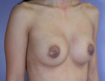 Breast Augmentation before and after photo