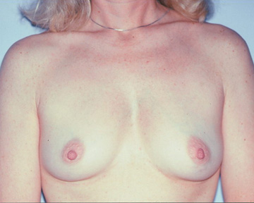 Breast Augmentation before and after photo