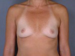 Breast Augmentation Before and after photo