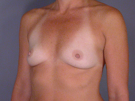 Breast Augmentation before and after photo