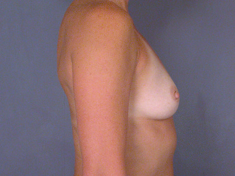 Breast Augmentation before and after photo