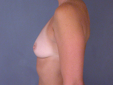 Breast Augmentation before and after photo