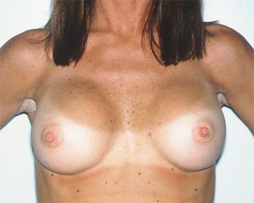 Breast Implant Correction before and after photo