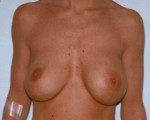 Breast Implant Correction Before and after photo