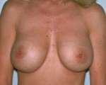 Breast Implant Correction Before and after photo