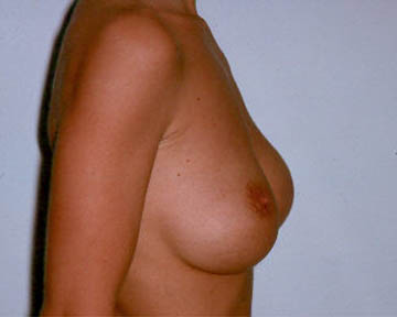 Breast Implant Correction before and after photo