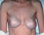 Breast Implant Correction Before and after photo