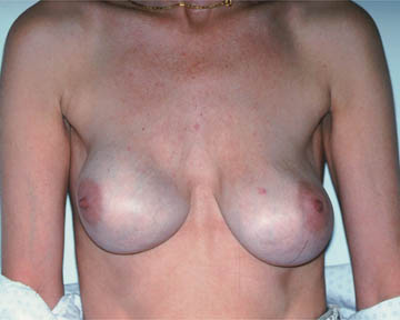 Breast Implant Correction before and after photo