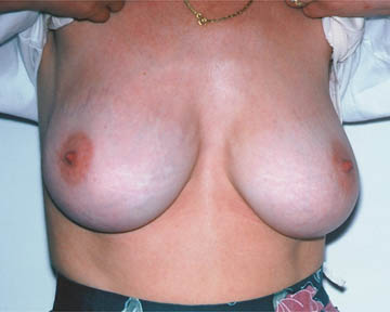 Breast Implant Correction before and after photo