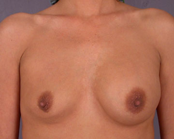 Breast Implant Correction before and after photo