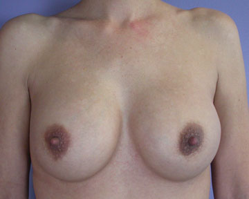 Breast Implant Correction before and after photo