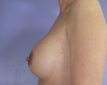 Breast Implant Correction before and after photo