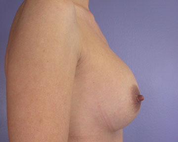 Breast Implant Correction before and after photo